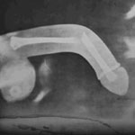 broken penis x-ray